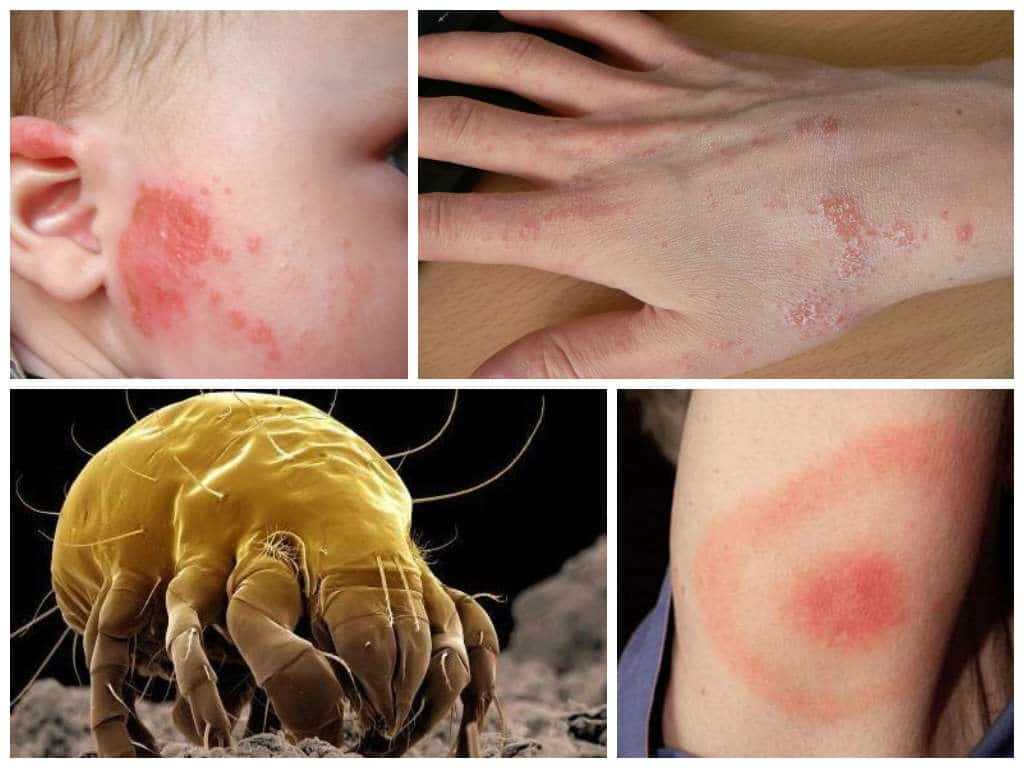 Как лечить аллергическую реакцию на пылевых клещей?